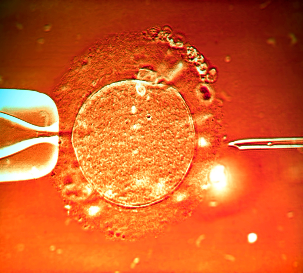 ICSI (Intracytoplasmic Sperm Injection) – Dr. Divya Venugopalan, Bengaluru