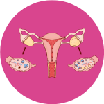 PCOS Nutritionist Near Me