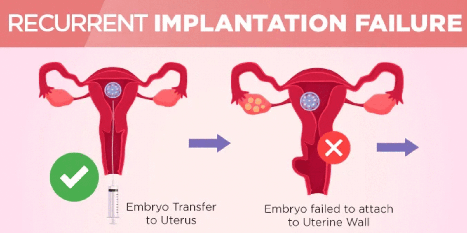 Recurrent implantation failure – Dr. Divya Venugopalan, Bengaluru