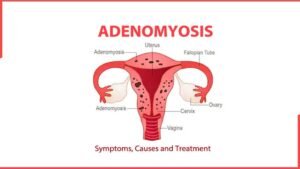 Illustration of a female uterus showing adenomyosis with thickened uterine walls and endometrial tissue growing into the muscle layer.
